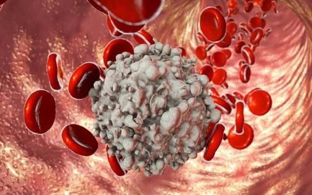 白血病自我診斷和護(hù)理措施